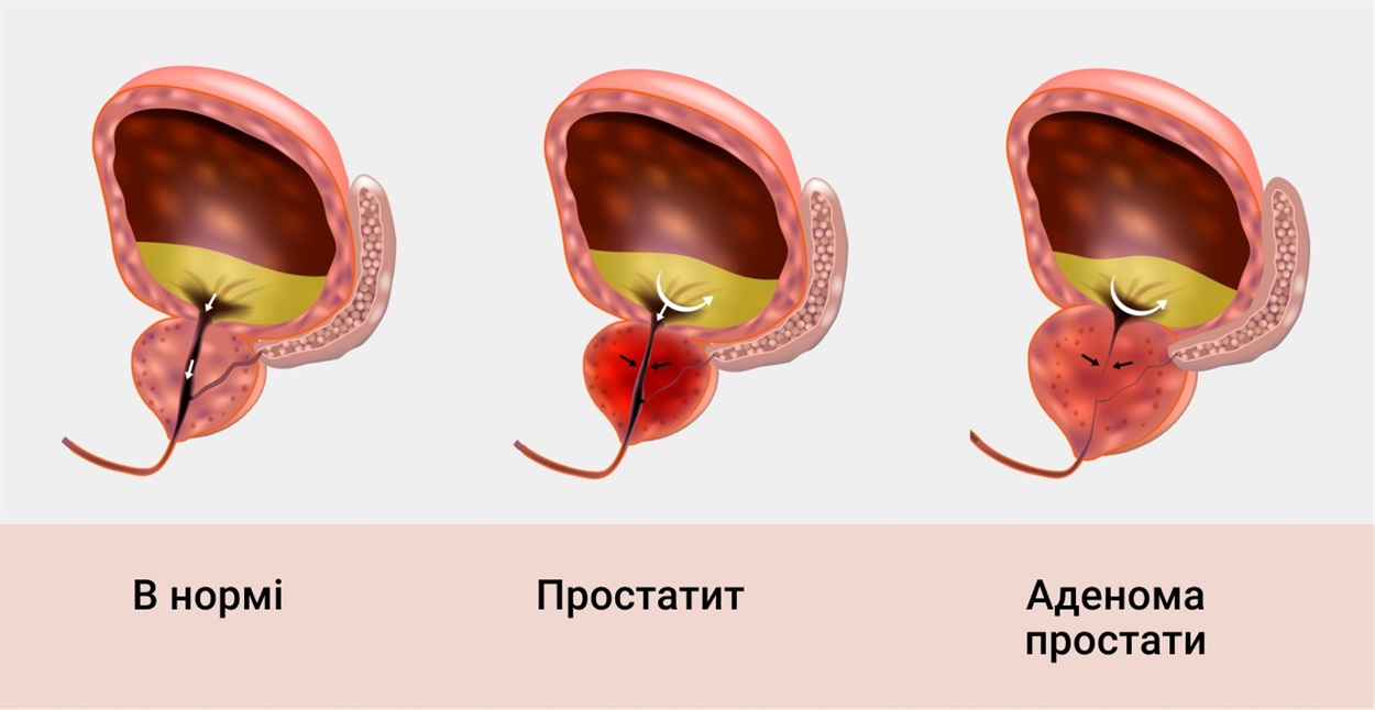 Передміхурова залоза
