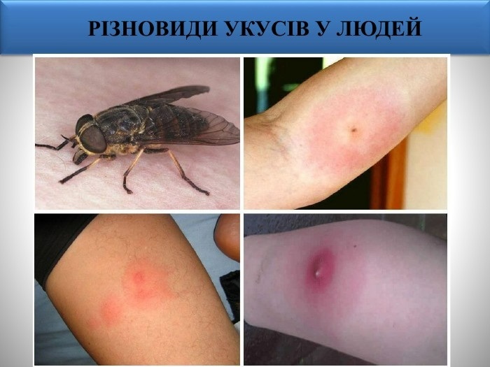укус гедзя